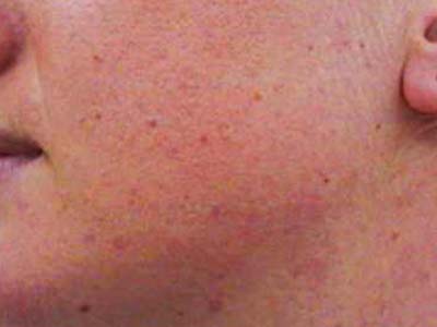 Aντιμετωπίστε τις μελαγχρωματικές βλάβες